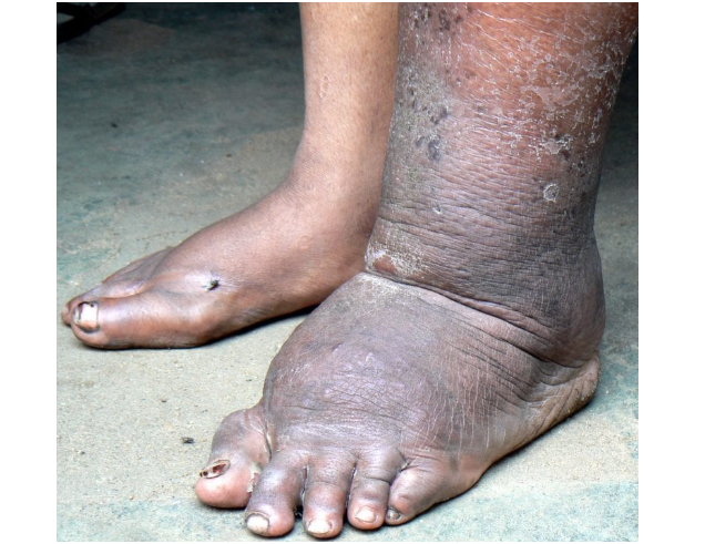 You are currently viewing SENGA HILL LAUNCHES FILARIAL DISEASE SENSITISATION PROGRAMME