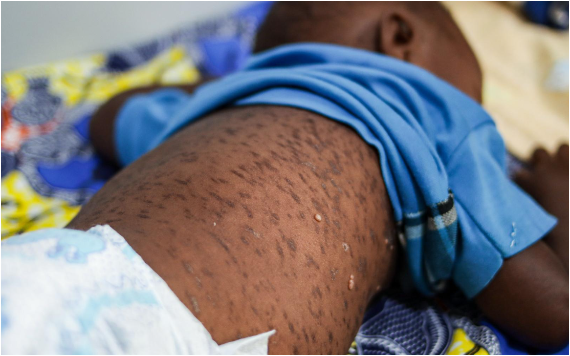 You are currently viewing CASES OF MEASLES RISE IN SHANGOMBO DISTRICT