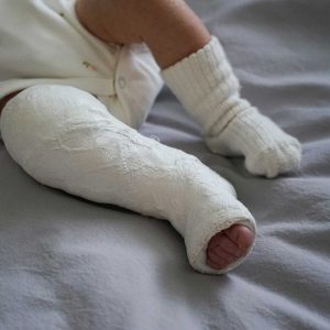 Read more about the article Approximately 808 children are born with clubfoot in Zambia every year
