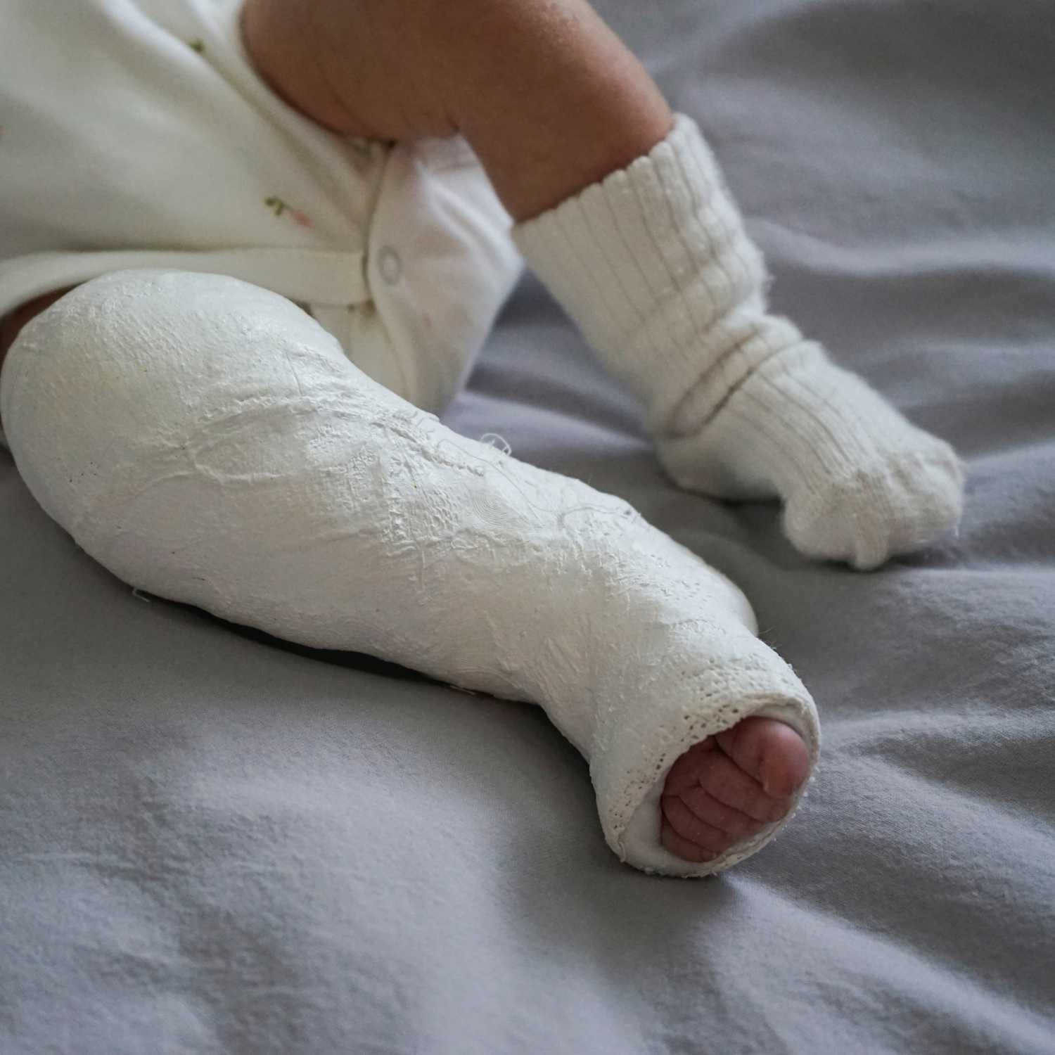 You are currently viewing Approximately 808 children are born with clubfoot in Zambia every year